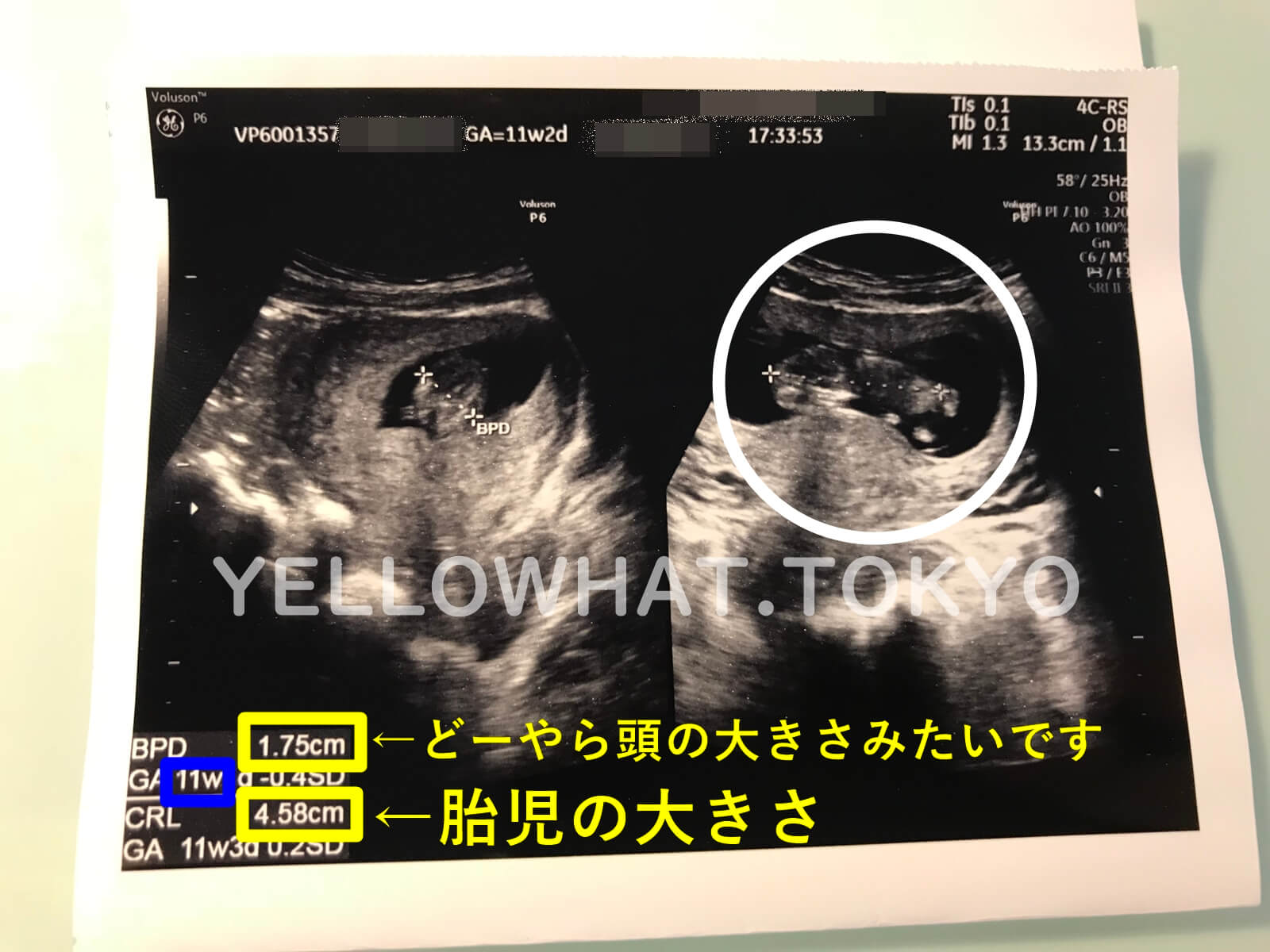 妊娠週数10 11 12週目の妻と赤ちゃんは 出血や流産の可能性 エコーでの胎児の大きさ 頭痛など Yellowhat 男の子育てブログ