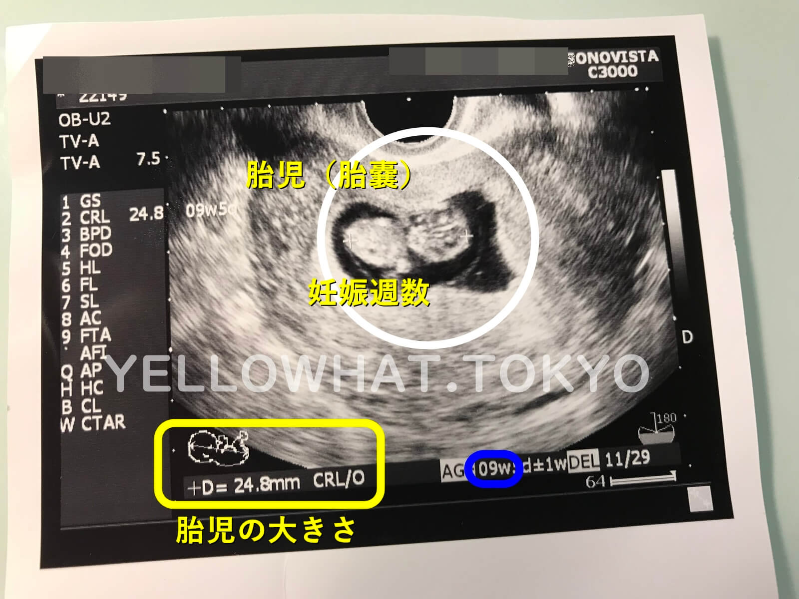 妻の妊娠初期7 8 9週目の状態 エコーやお腹の大きさ つわり 出血 流産 腹痛 Yellowhat 男の子育てブログ