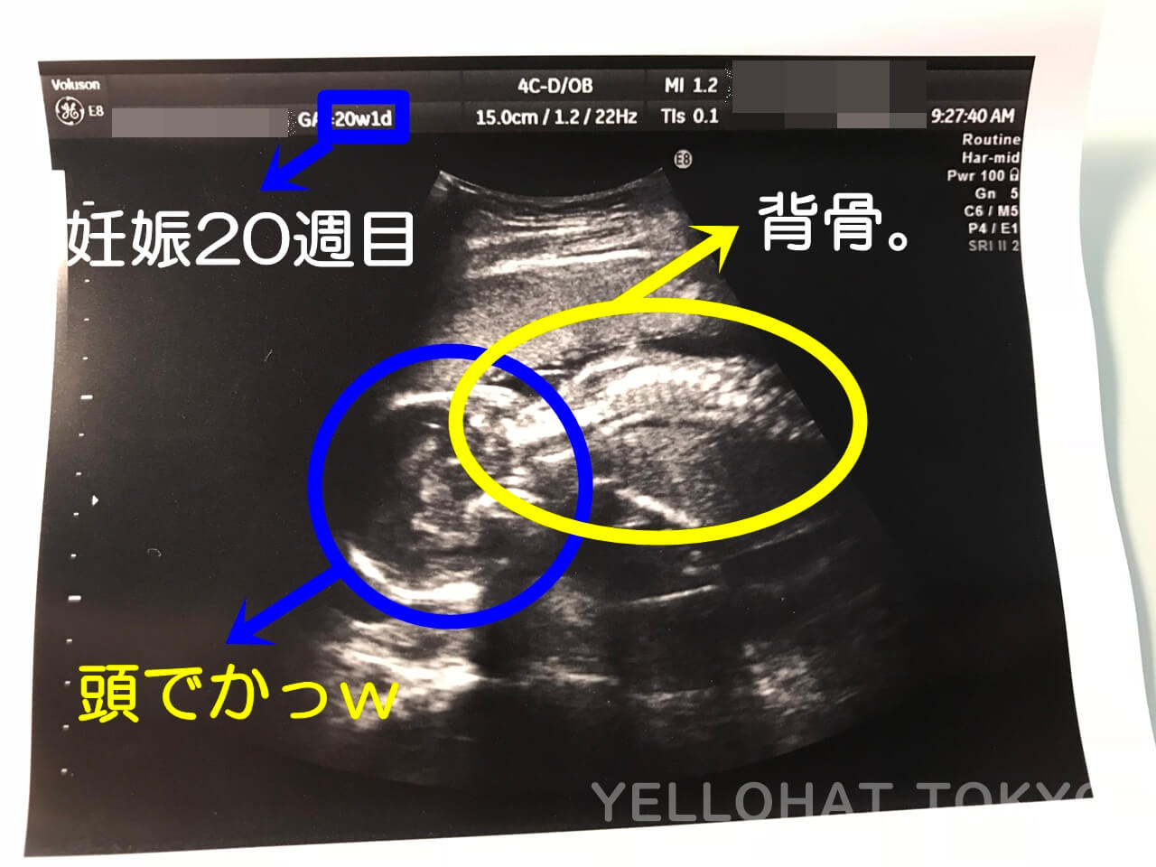 妊娠中期 安定期 16 21週目 エコーでの赤ちゃんの大きさ 性別
